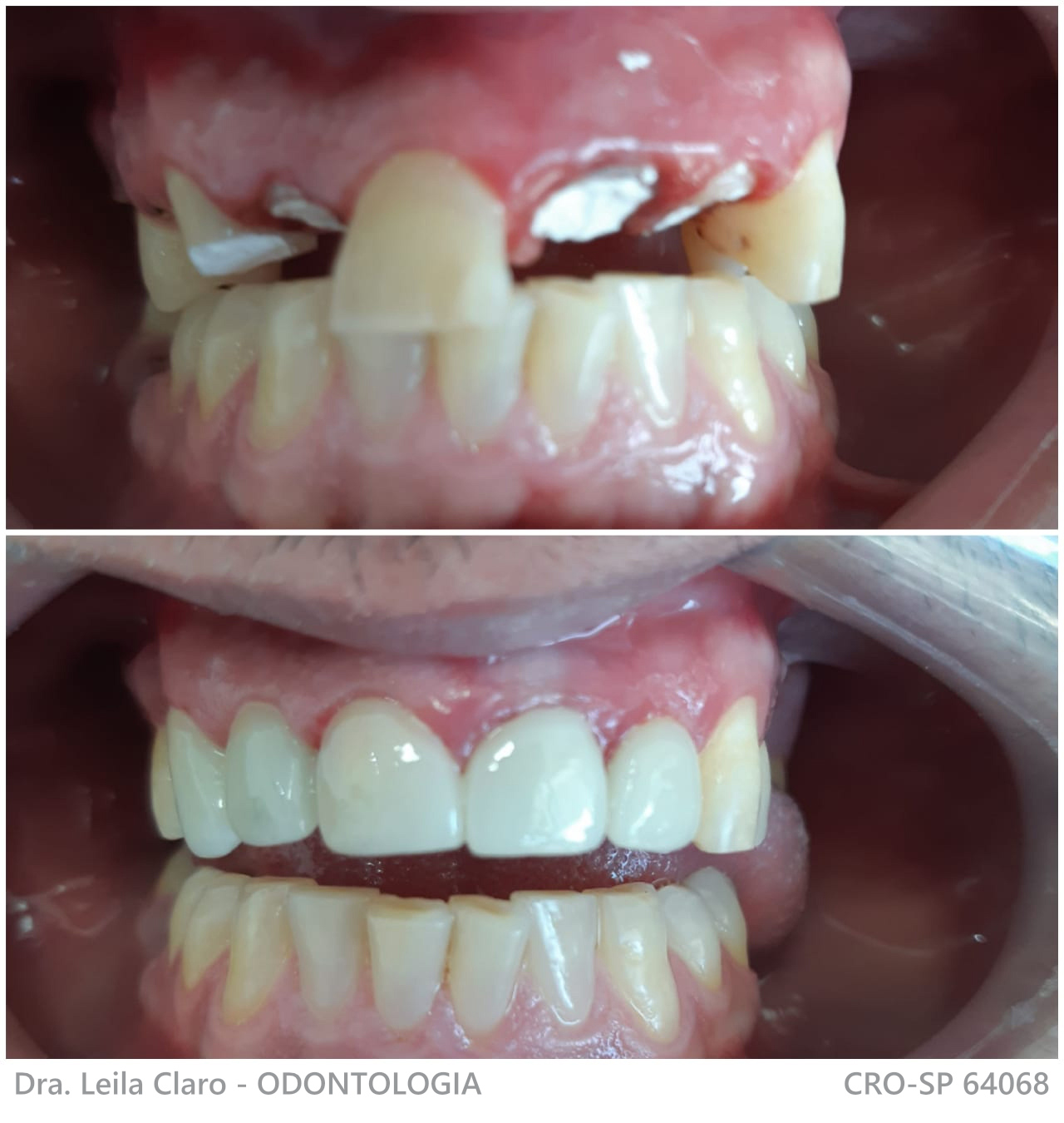 Recuperação dos dentes com núcleos e coroas após acidente