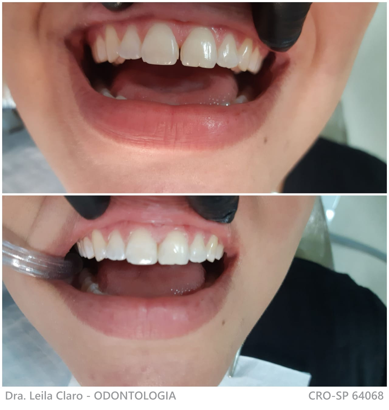 Restaurações estéticas