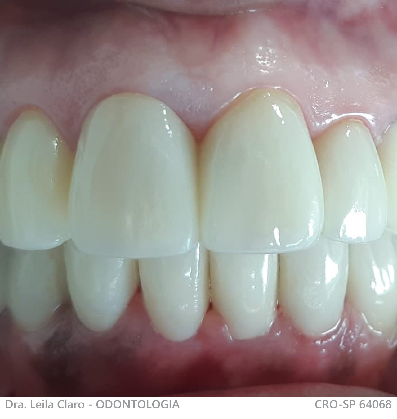 reabilitação com coroas de porcelana